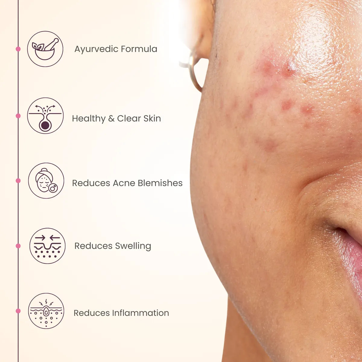 Acne Controll Gel 50 Gm For Clear Healthy Skin